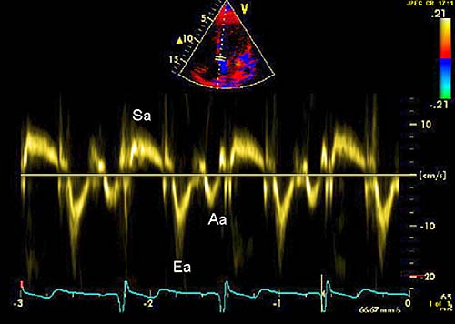 Espectro de Doppler tisular del anillo mitral
