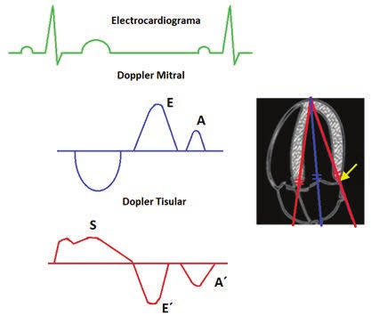 Relación entre Doppler mitral y Doppler tisular