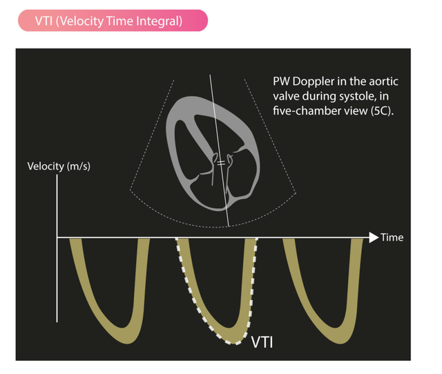 VTI TSVI ejemplo 1